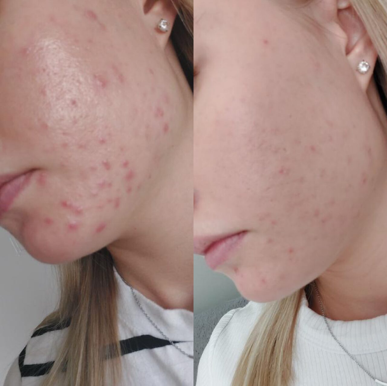 Metamorfoza po zabiegu kosmetologicznym – Turowska Clinic