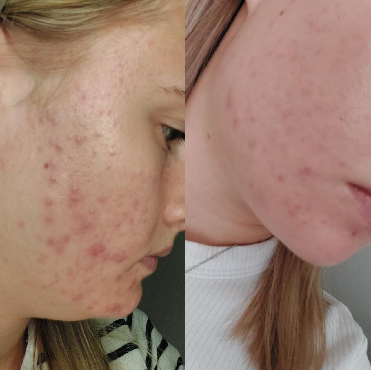 Zabieg pielęgnacyjny skóry twarzy – efekt przed i po