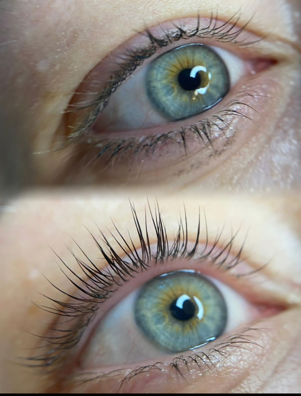 Efekt redukcji owłosienia laserem diodowym – Turowska Clinic