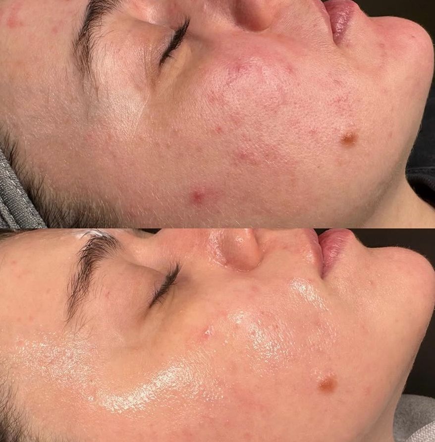 Transformation after a laser treatment – Kleczew clinic
