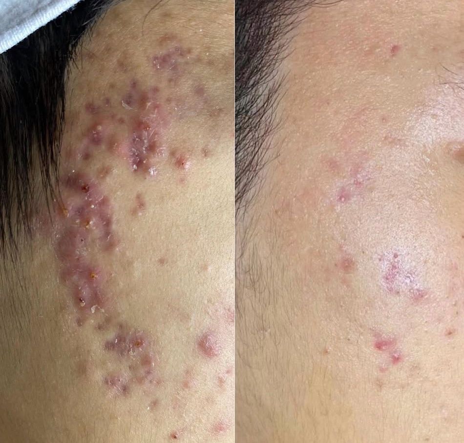 Effect of laser hair removal – Turowska Clinic Kleczew
