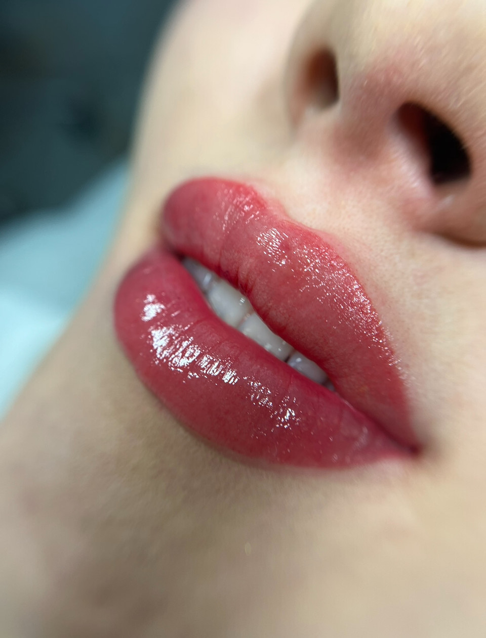 Powiększanie i modelowanie ust kwasem hialuronowym – Turowska Clinic Kleczew