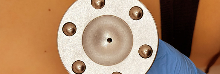 Dermomasaż podciśnieniowy – redukcja cellulitu, Turowska Clinic Kleczew