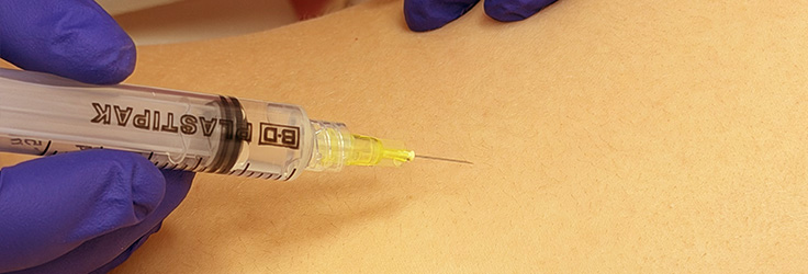 Osocze bogatopłytkowe PRP – regeneracja skóry, Turowska Clinic Kleczew