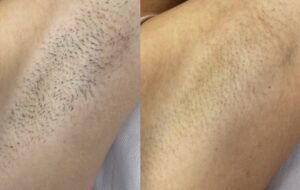 Depilacja laserowa, pachy po 5 sesjach: zdjęcie przed i po, klientka Turowska Clinic