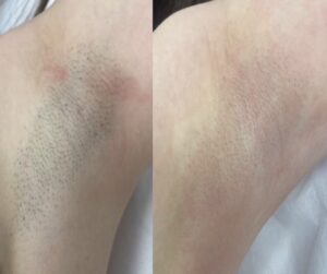 Depilacja laserowa, pachy po 4 sesjach: zdjęcie przed i po, klientka Turowska Clinic