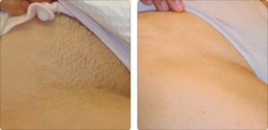 Depilacja laserowa, bikini po 6 sesjach: zdjęcie przed i po, klientka Turowska Clinic