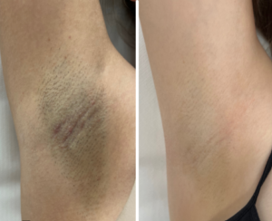 Depilacja laserowa, pachy po 8 sesjach: zdjęcie przed i po, klientka Turowska Clinic