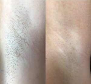 Depilacja laserowa, pachy po 6 sesjach: zdjęcie przed i po, klientka Turowska Clinic