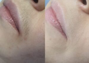 Depilacja laserowa, wąsik po 5 sesjach: zdjęcie przed i po, klientka Turowska Clinic