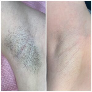 Depilacja laserowa, pachy po 4 sesjach: zdjęcie przed i po, klientka Turowska Clinic