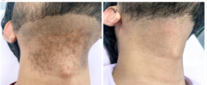 Depilacja laserowa, broda po 4 sesjach: zdjęcie przed i po, klientka Turowska Clinic