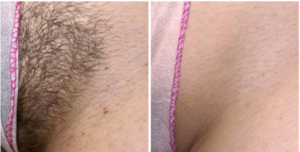 Depilacja laserowa, bikini po 5 sesjach: zdjęcie przed i po, klientka Turowska Clinic